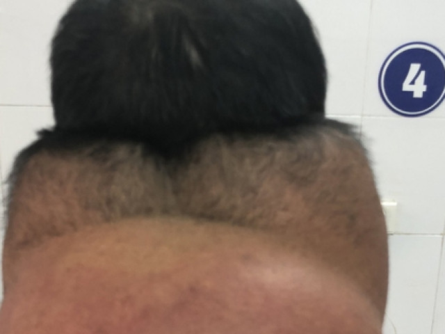 Sức khỏe đời sống - Tiêu thụ rượu nhiều, dễ có nguy cơ mắc bệnh hiếm gặp Madelung