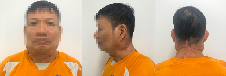 Bệnh nhân "người gấu" Madelung sau khi phẫu thuật