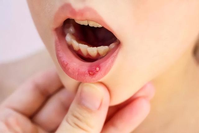 Thiếu vitamin C có thể dẫn đến chảy máu nướu răng, loét miệng và vết thương ngoài da lâu không lành.