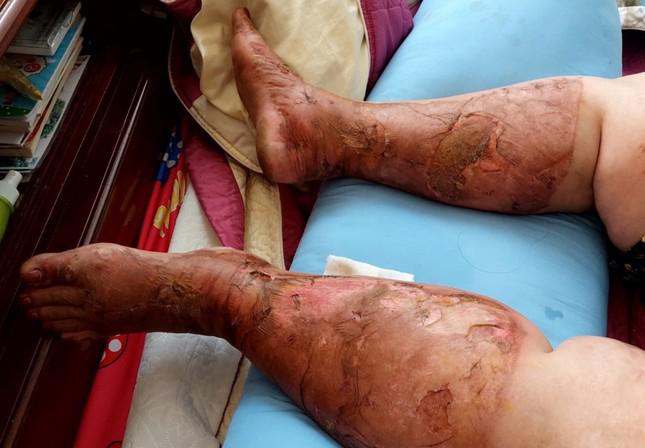 Đôi chân bà Hạnh bị bỏng nặng sau vụ việc.