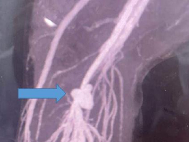 Sức khỏe đời sống - Bé trai suýt bị cắt cụt chân vì vết thương "bé tí"