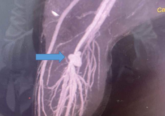 Vị trí động mạch bị rách tạo thành túi phình khiến bệnh nhi đau đớn dữ dội (ảnh: BSCC)
