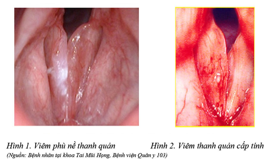 Biến chứng của viêm thanh quản có thể đe dọa tính mạng, khi nào cần đi khám? - 1