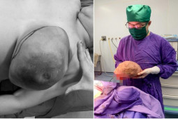 Sức khỏe đời sống - Người phụ nữ có ngực khủng gấp chục lần người bình thường