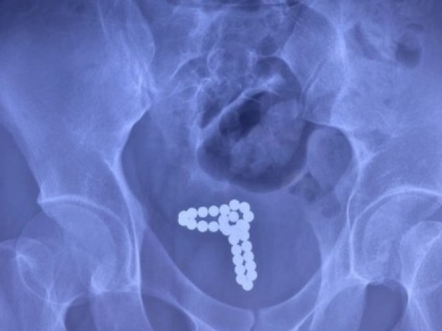 Sức khỏe đời sống - Nam thanh niên gặp nạn vì dùng chuỗi bi kim loại 'tự sướng'