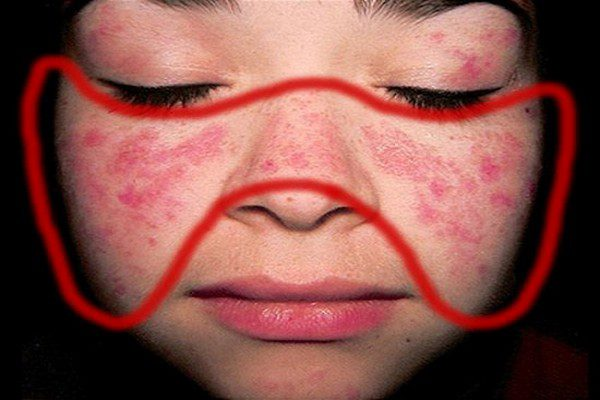 Hồng ban hình cánh bướm ở người lupus ban đỏ