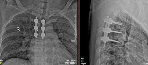 Theo bác sĩ Thịnh, sau mổ bệnh nhân diễn biến ổn định, phục hồi tốt và đang được các bác sĩ theo dõi - (ảnh BVCC).