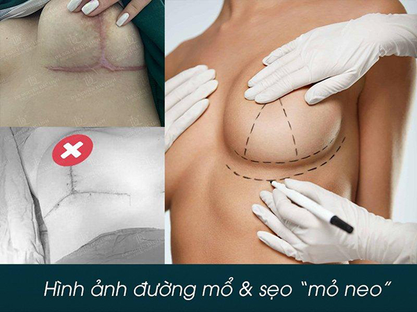 Sẹo mổ của ca phẫu thuật nâng ngực đường mổ neo