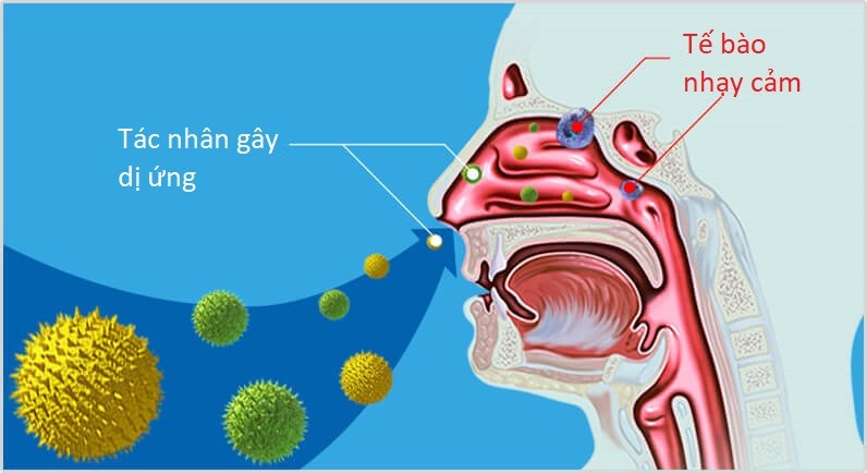 Hắt hơi, nghẹt mũi, chảy nước mũi - Cẩn trọng viêm mũi dị ứng mạn tính - 1
