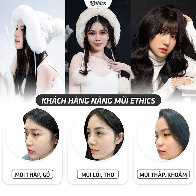 Một số hình ảnh khách hàng nâng mũi tại thẩm mỹ viện Ethics