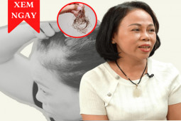 Sức khỏe đời sống - Thoát chứng rụng tóc nhiều, hói đầu đeo bám suốt 5 năm nhờ cách này
