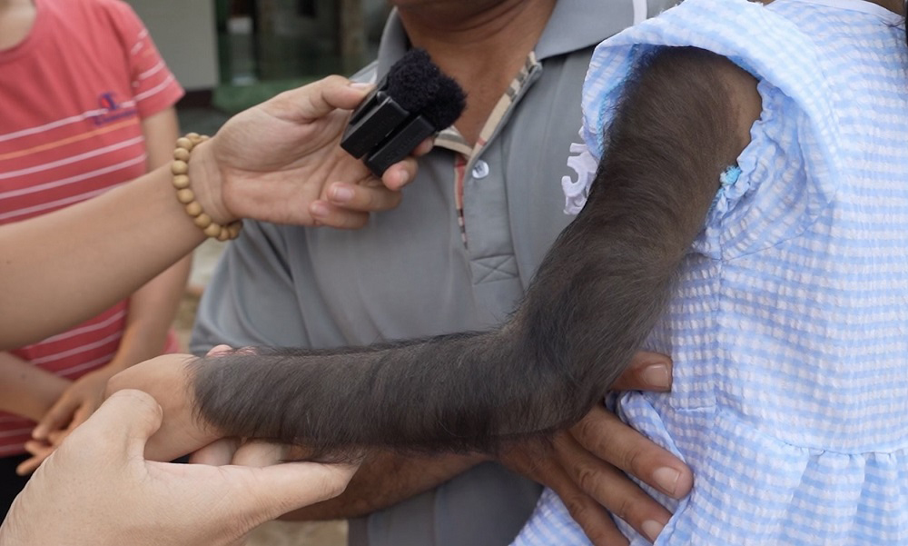 Cánh tay của bé Úc mang một màu đen, mọc đầy lông lá