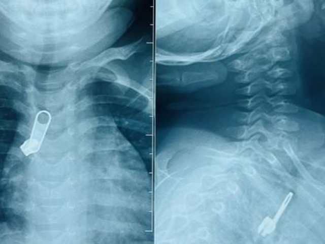 Sức khỏe đời sống - Móc khóa "đi lạc" vào phế quản bé trai vì sai lầm của người lớn