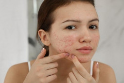 Làm đẹp - Các cách giúp giảm thâm và mẩn đỏ cực nhanh khi bị mụn