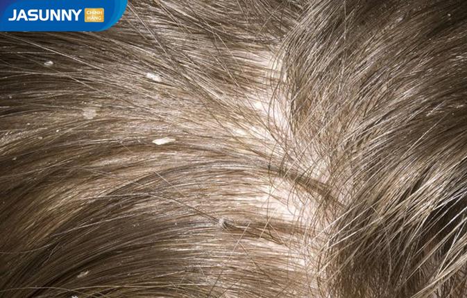 Gàu, ngứa - Nỗi “ám ảnh” của nhiều người