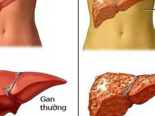 Cơ thể có 1 trong 7 dấu hiệu này chứng tỏ gan của bạn đang ”kêu cứu”