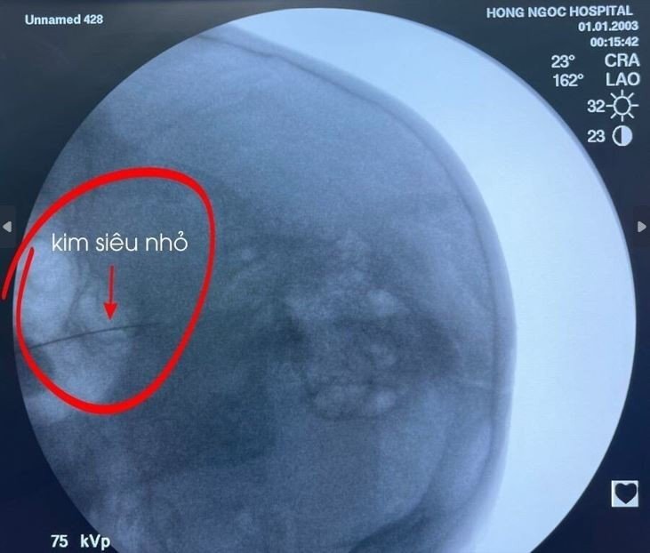 Kim tiêm siêu nhỏ được sử dụng để tiêm cồn