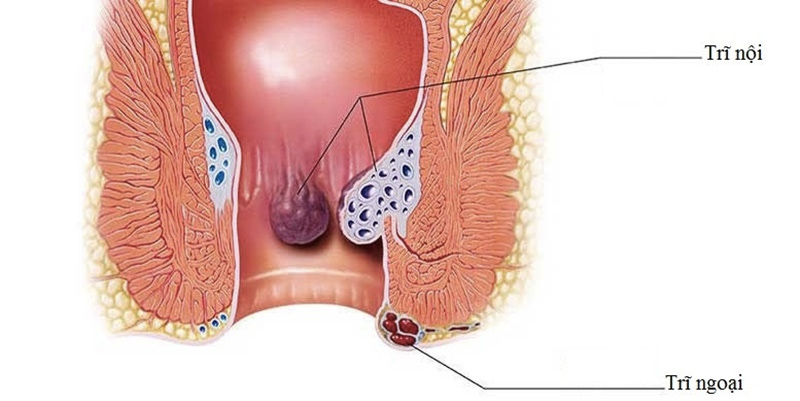 Khu vực bị trĩ rất dễ viêm và nhiễm khuẩn (do tiếp xúc thường xuyên với phân)