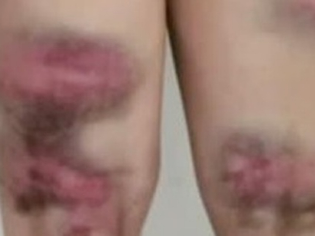 Bạn trẻ - Cuộc sống - Bị mẹ vác gậy đánh bầm tím cả người vì 30 tuổi chưa có người yêu và cái kết gây sốc