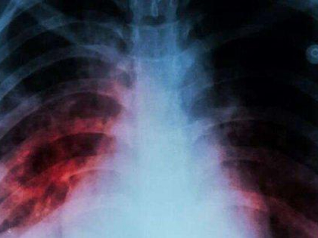 Sức khỏe đời sống - WHO: Một bệnh cũ trỗi dậy sau 20 năm, đang gây tử vong nhiều hơn COVID-19