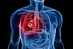 Sức khỏe đời sống - 3 triệu chứng tưởng như cảm lạnh nhưng lại là ung thư phổi