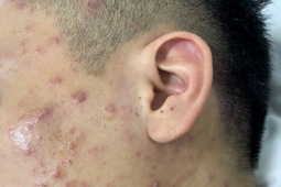 Sức khỏe đời sống - Số ca mắc thủy đậu tăng 140 lần, Hà Nội có nguy cơ bùng phát dịch