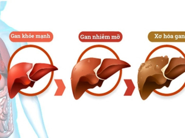 Người bị gan nhiễm mỡ không ăn 5 nhóm thực phẩm này để giảm gánh nặng cho gan!