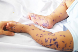 Sức khỏe đời sống - Sai lầm hàng nghìn người vẫn mắc khi chăm sóc, điều trị bệnh thủy đậu