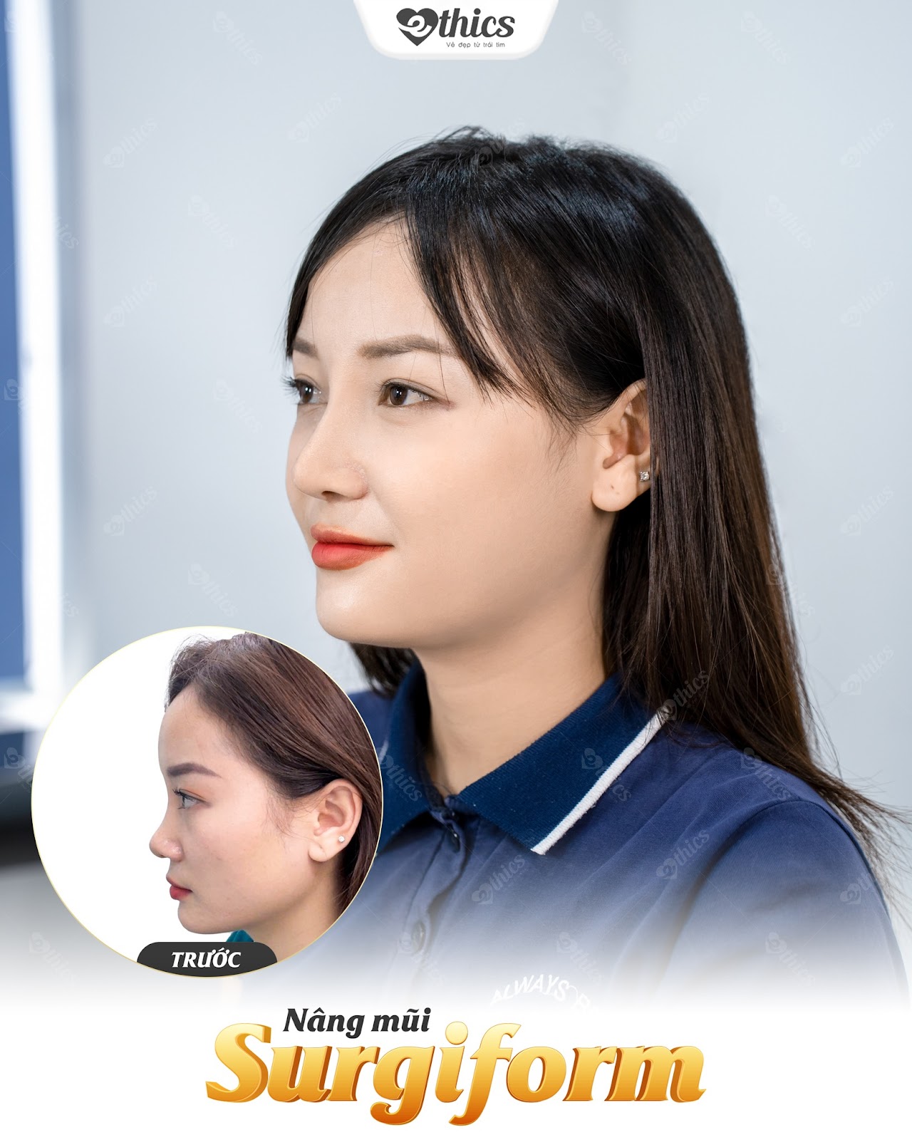 Sự thay đổi ngoạn mục của khách hàng sau khi nâng mũi Surgiform tại Thẩm mỹ viện Ethics