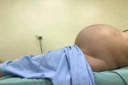 Sức khỏe đời sống - Ngỡ bụng to do béo, người phụ nữ đi khám mới sững sờ khi biết có u tử cung gần 10kg