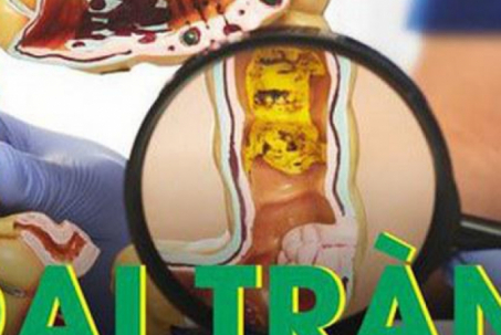 Viêm đại tràng mạn tính dễ chuyển hóa thành ung thư