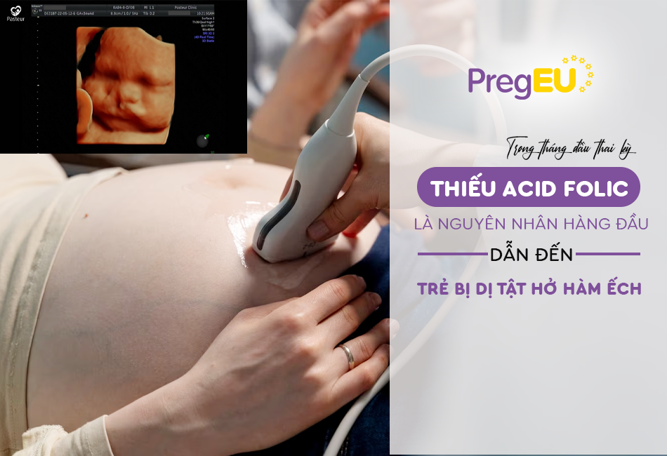 Thiếu acid folic khi mang thai có thể dẫn đến dị tật hở hàm ếch ở trẻ em