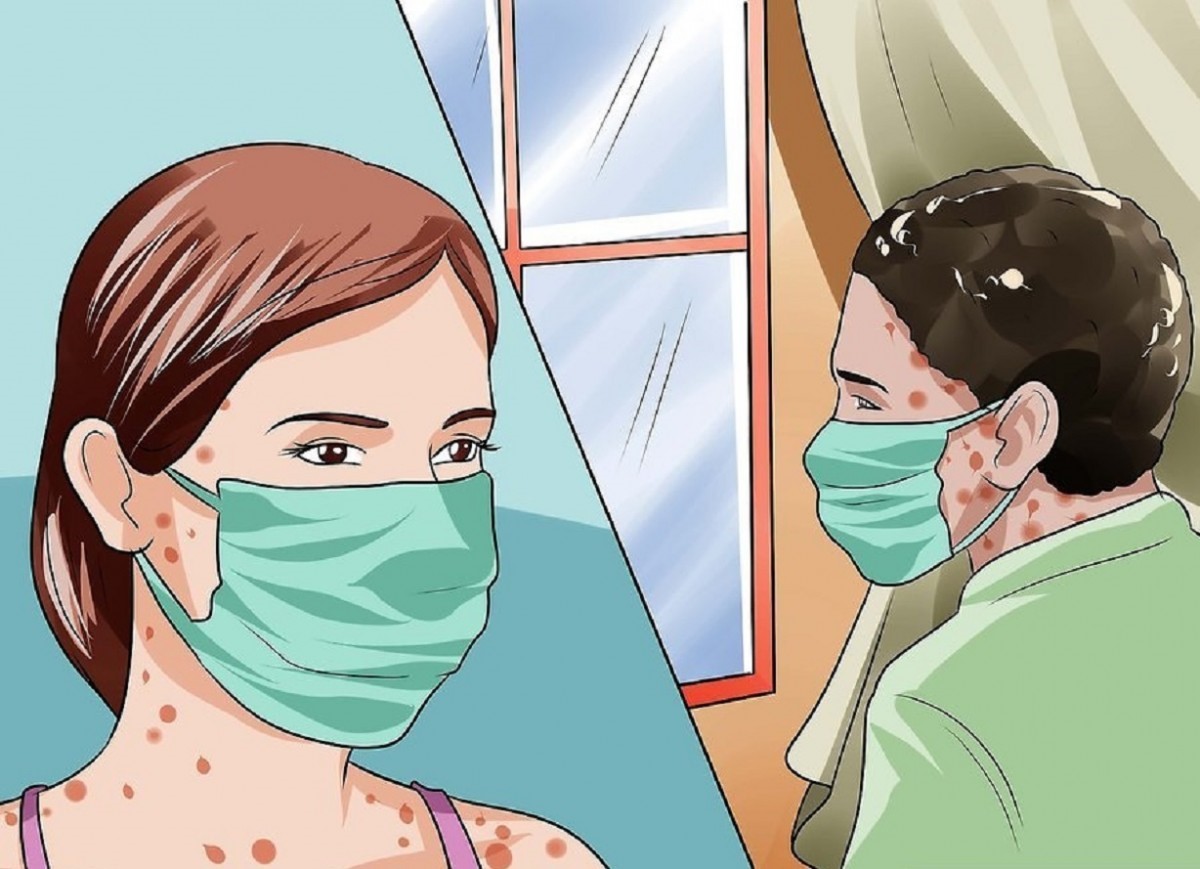 Người mắc thủy đậu nên hạn chế ra ngoài để phòng ngừa lây nhiễm