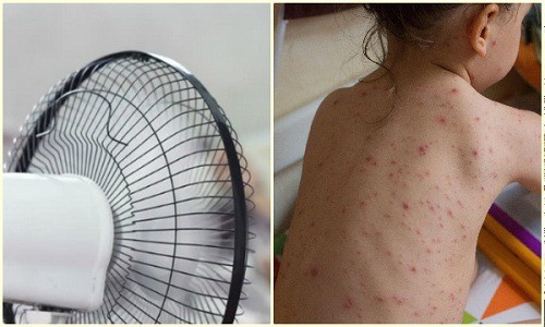 Người bị thủy đậu có thể bật quạt nhẹ nhàng