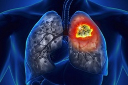 Sức khỏe đời sống - Đau thắt lưng, người đàn ông đi khám mắc cùng lúc 2 loại ung thư