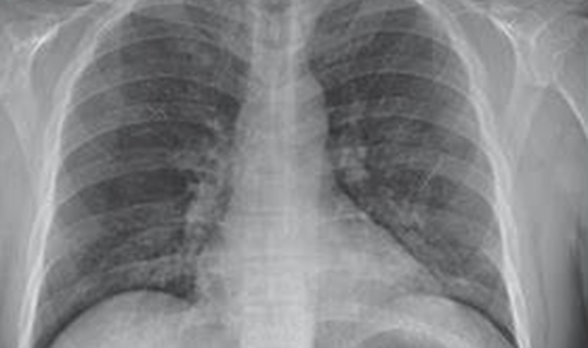 Người phụ nữ có phổi trắng xóa sau 3 ngày nhiễm cúm A - 1