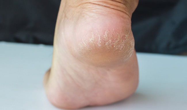 5 dấu hiệu bệnh gan nguy hiểm thể hiện ở bàn chân rất ít người để ý - 3