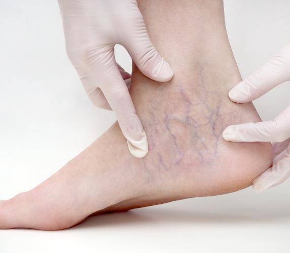 5 dấu hiệu bệnh gan nguy hiểm thể hiện ở bàn chân rất ít người để ý - 2