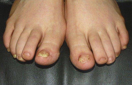5 dấu hiệu bệnh gan nguy hiểm thể hiện ở bàn chân rất ít người để ý - 4