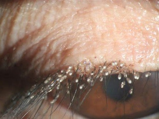 Sức khỏe đời sống - Rận ký sinh và đẻ trứng chi chít trên mi mắt người phụ nữ