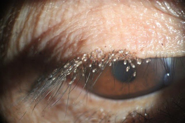 Hình ảnh rận ký sinh và đẻ trứng trên mi mắt nữ bệnh nhân