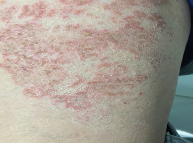 Tổn thương vùng da là một trong những biểu hiện điển hình nhất khi mắc bệnh ký sinh trùng. Ảnh BVCC