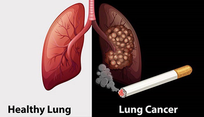 Vì sao chồng hút thuốc lá vợ lại mắc ung thư phổi, chuyên gia ung thư nói gì?- Ảnh 2.