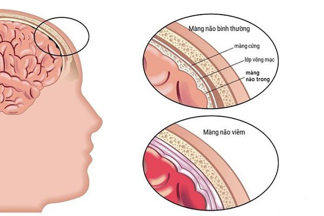 Thanh niên 21 tuổi đau đầu, ngủ li bì, đến bệnh viện mới biết u màng não, chuyên gia khuyến cáo cơ thể có 7 dấu hiệu này cần khám ngay! - 2