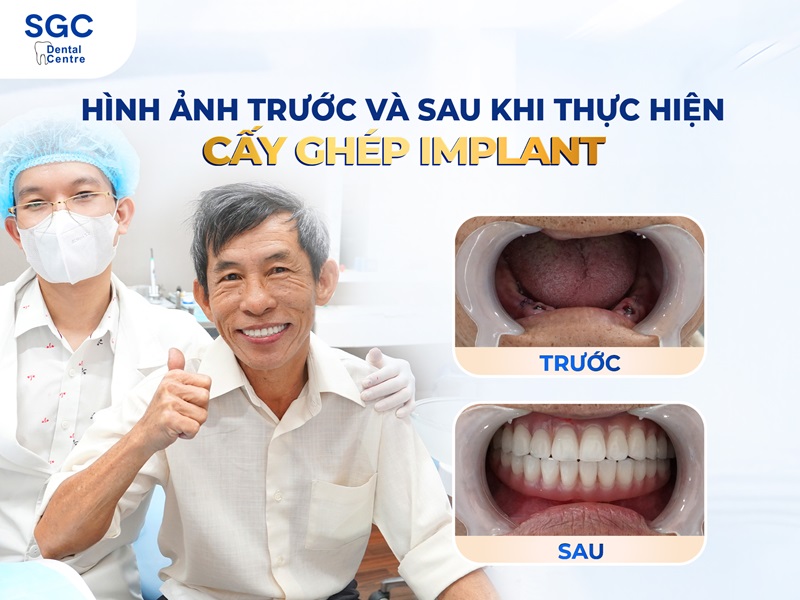 Dịch vụ trồng răng Implant uy tín TPHCM tại Nha Khoa SGC - 2