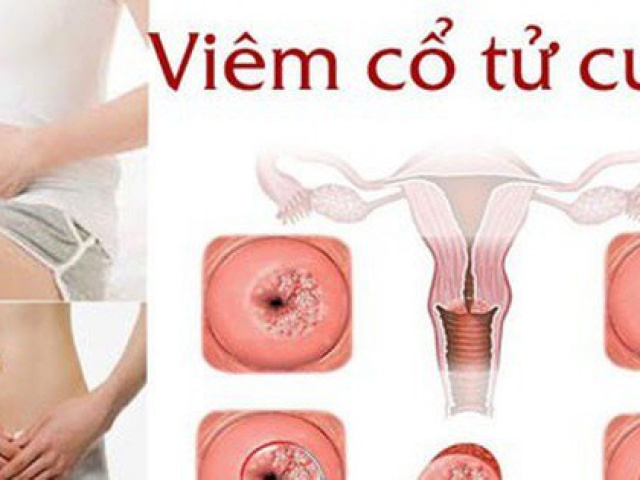 Sức khỏe đời sống - 4 cách phòng bệnh vùng kín hiệu quả, đây là 3 thực phẩm chị em cần tránh để bảo vệ tử cung