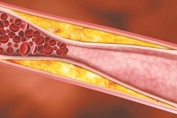 Sức khỏe đời sống - 7 thay đổi đơn giản trong lối sống để giảm cholesterol, phòng bệnh mỡ máu