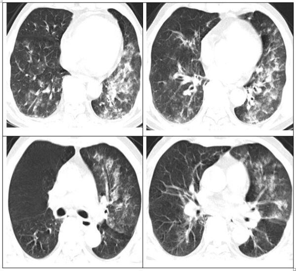 Hình ảnh phổi của người bệnh bị viêm lan tỏa và đông đặc.