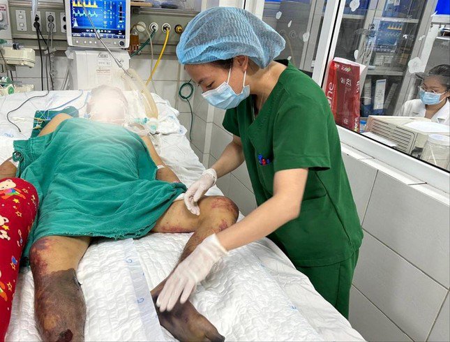 Bệnh nhân nhiễm liên cầu khuẩn lợn đã hoại tử tay chân.