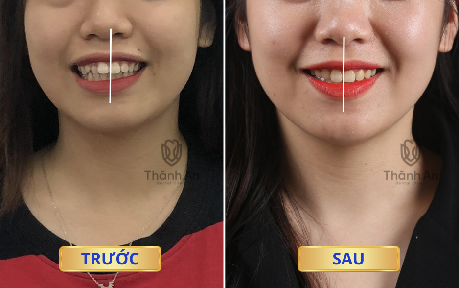 Niềng răng cải thiện sai lệch khớp cắn và mặt lệch như thế nào? - 2